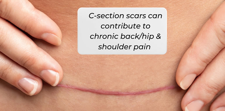 Uncovering The Secret Language Of Scars Custom Fit Physical Therapy 